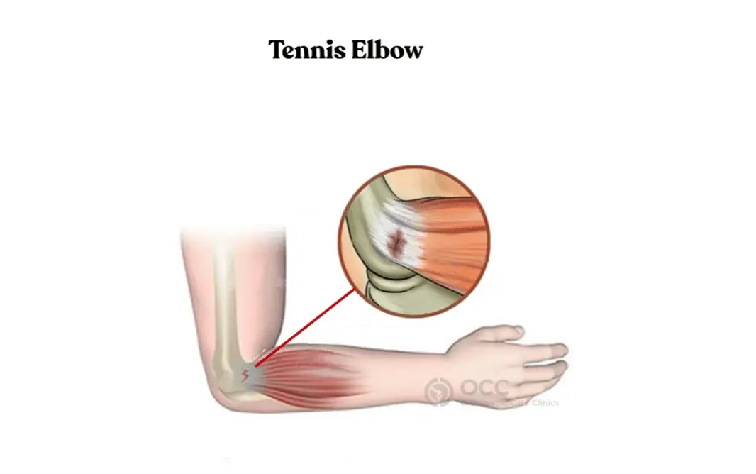 Anatomische schets van tenniselleboog met pijnlocatie aan de buitenzijde van de elleboog oftewel epicondylitis medialis.