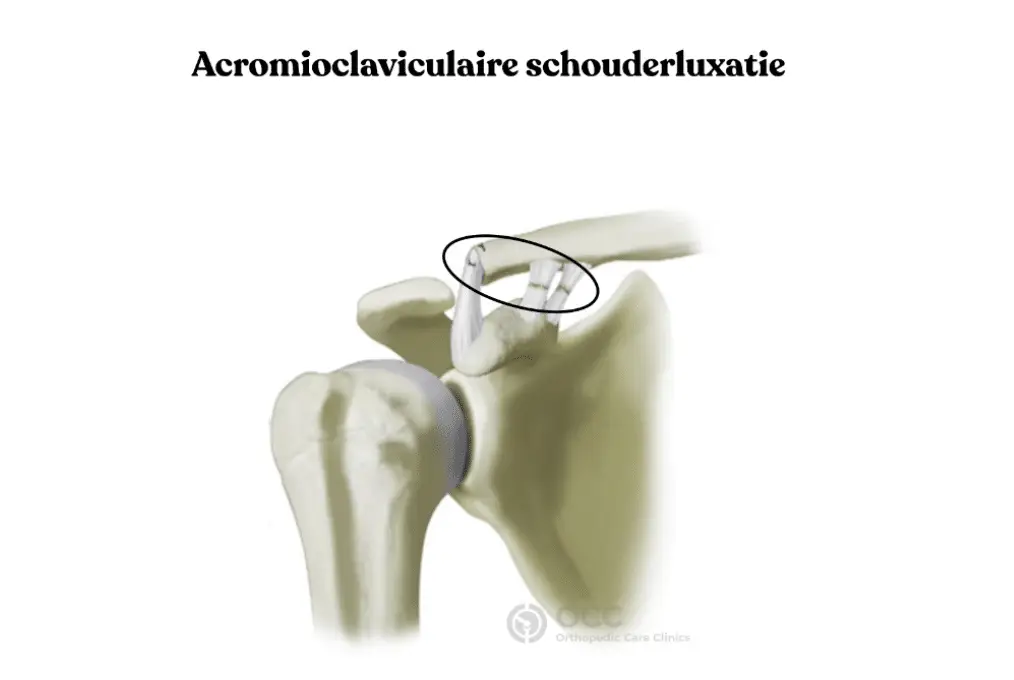 Anatomische tekening van een acromioclaviculaire luxatie van de schouder.