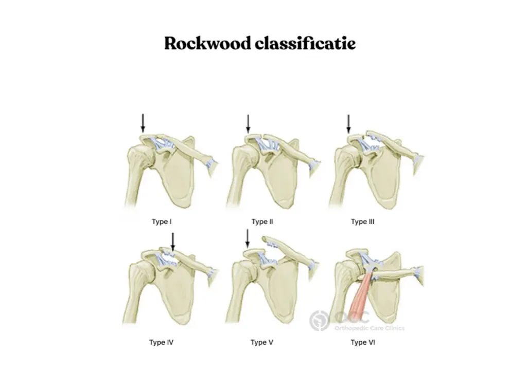 Anatomische weergave van de Rockwood classificatie bij AC luxatie (type 1 tot 6).