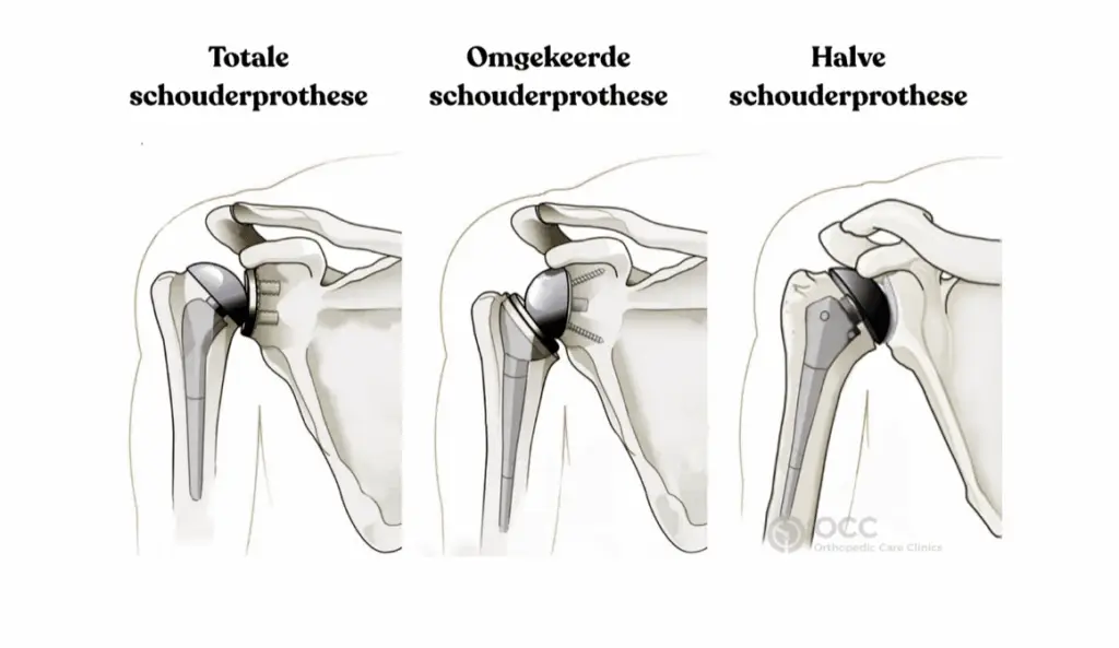 Overzicht van schouderprothesen: totale, omgekeerde en halve schouderprothese.