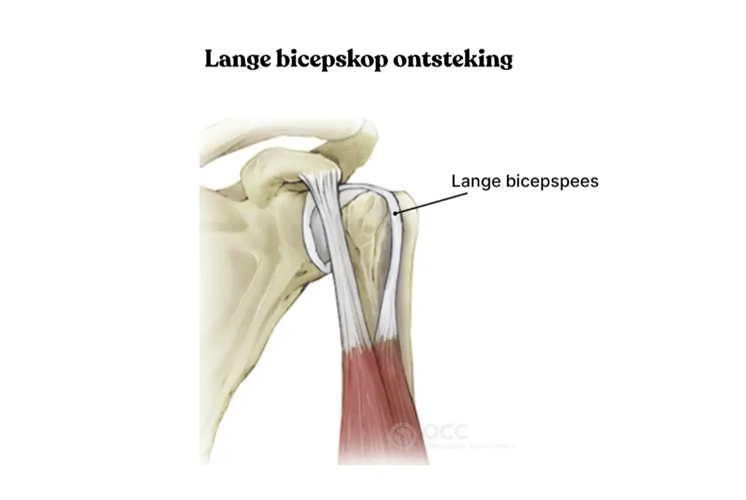 Anatomische weergave van het schoudergewricht met de lange bicepspees en ontsteking.