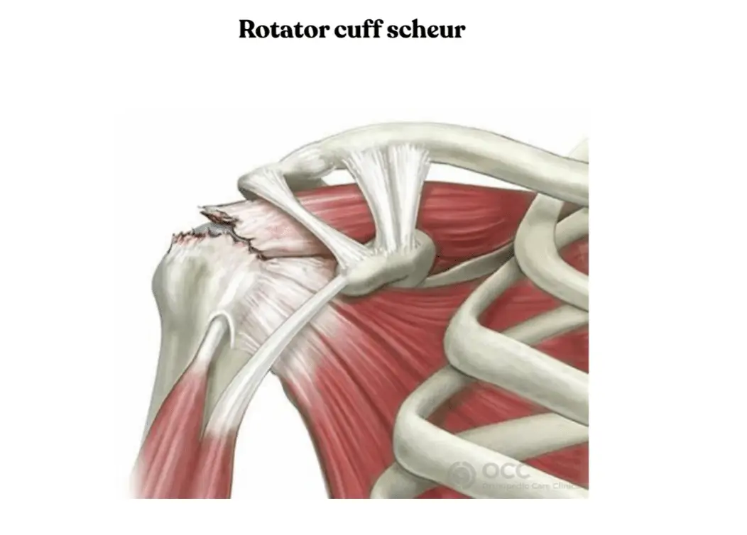 Anatomische tekening van de schouder met rotator cuff ruptuur.