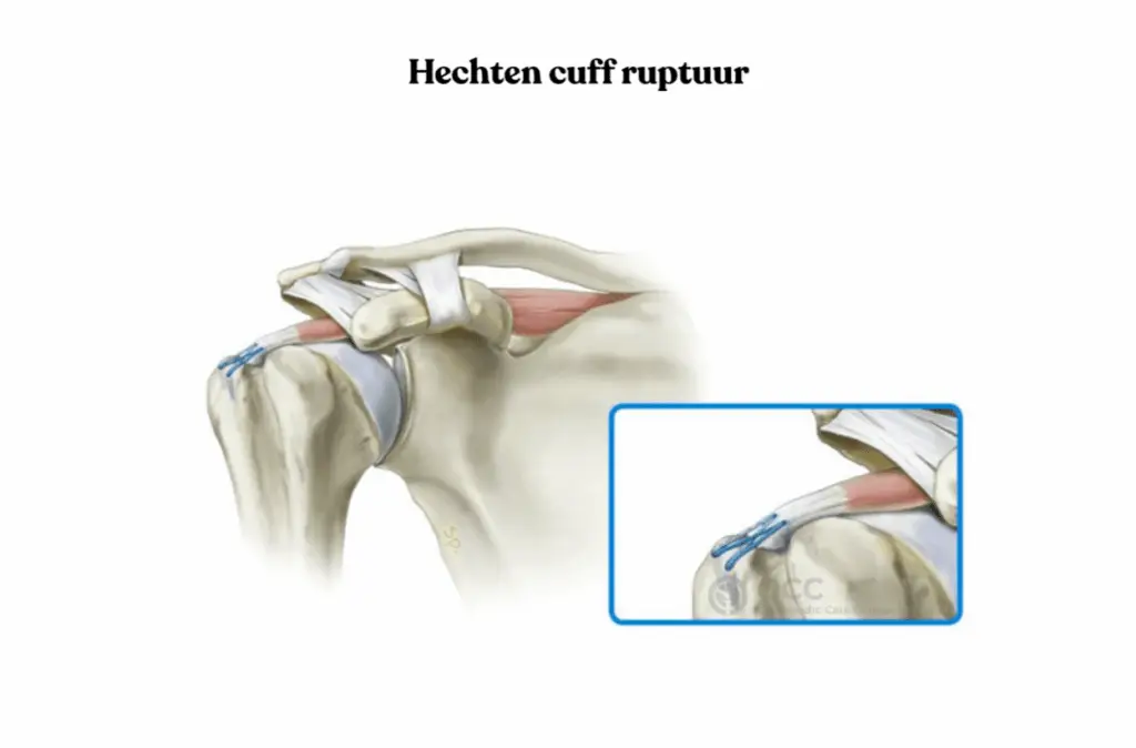 Anatomische tekening van de schouder met hechten van een rotator cuff ruptuur.