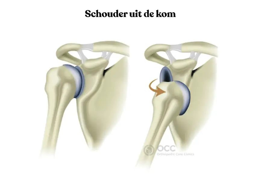 Schematische weergave van een schouder die uit de kom is (schouderluxatie).