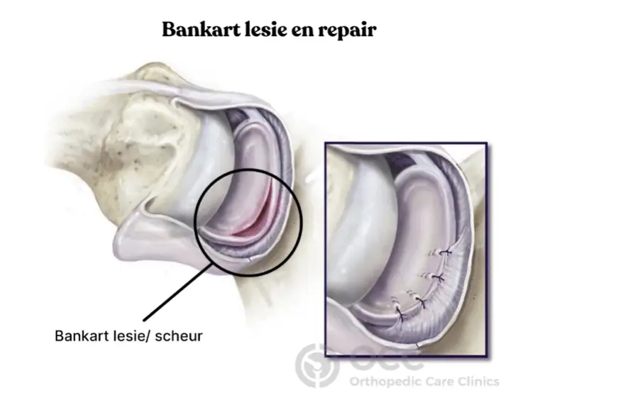 Illustratie van een kijkoperatie van de schouder met herstel van het labrum (Bankart repair).