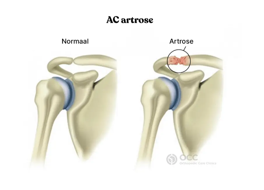Anatomische vergelijking van een normaal AC-gewricht en AC artrose in de schouder.