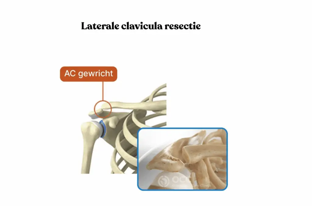 Anatomische tekening van het AC-gewricht met ingezoomd detail van het gewricht.