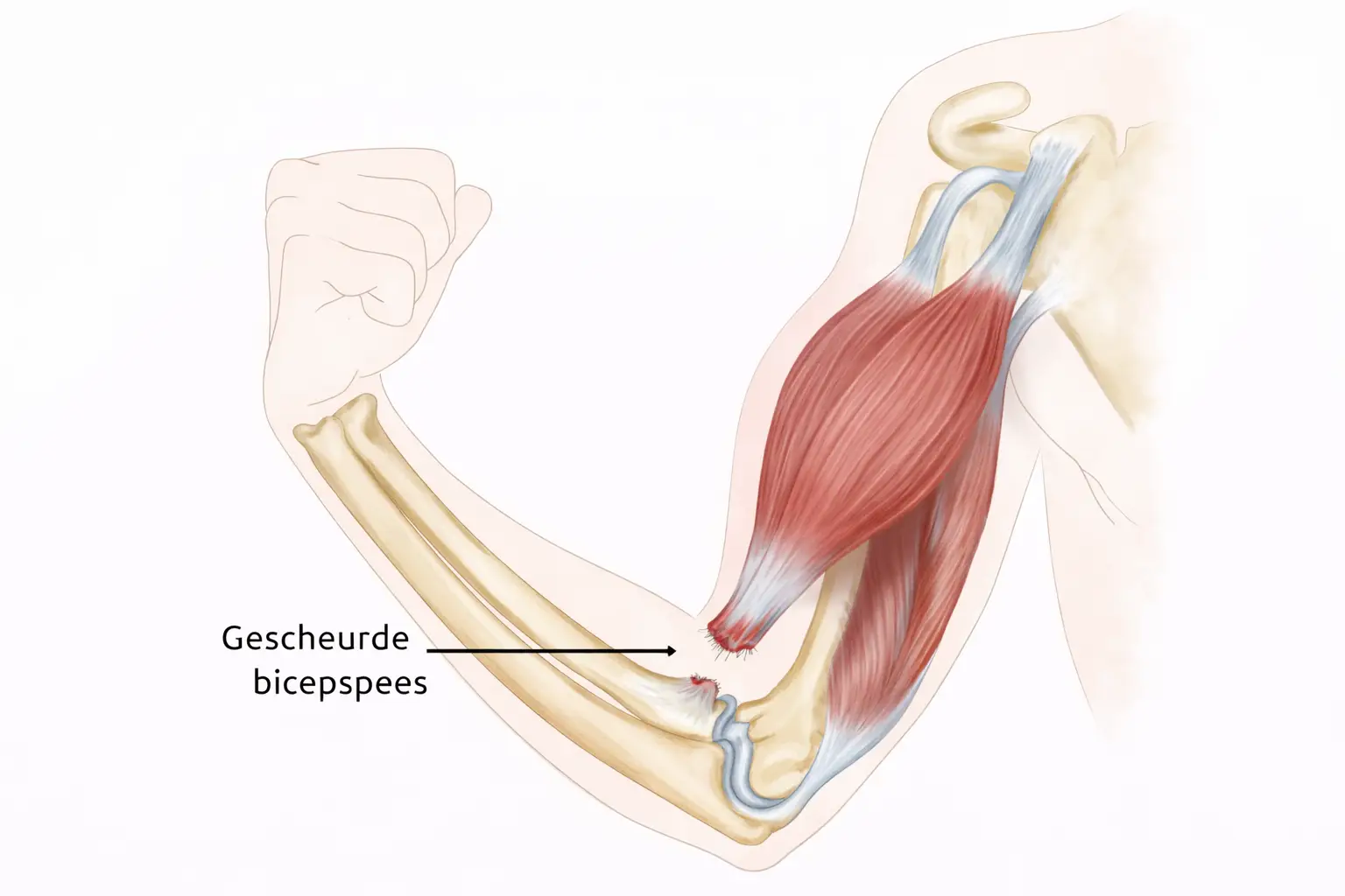 Anatomische illustratie van een gescheurde bicepspees bij de elleboog (distale bicepspees ruptuur).
