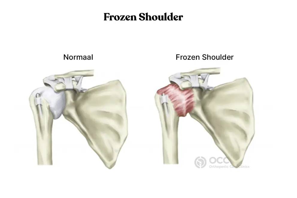 Anatomische tekening van een frozen shoulder met kapselverdikking.