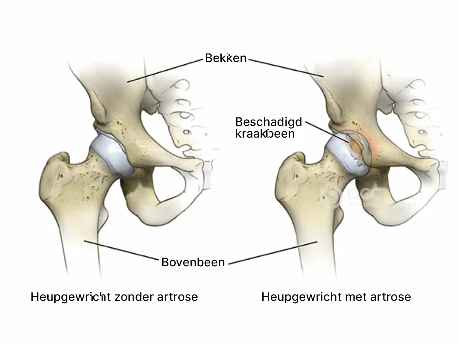anatomische illustratie met overzicht van onderdelen in de pelvis en heup gemaakt door orthopedisch chirurg John Cheung in Amsterdam.