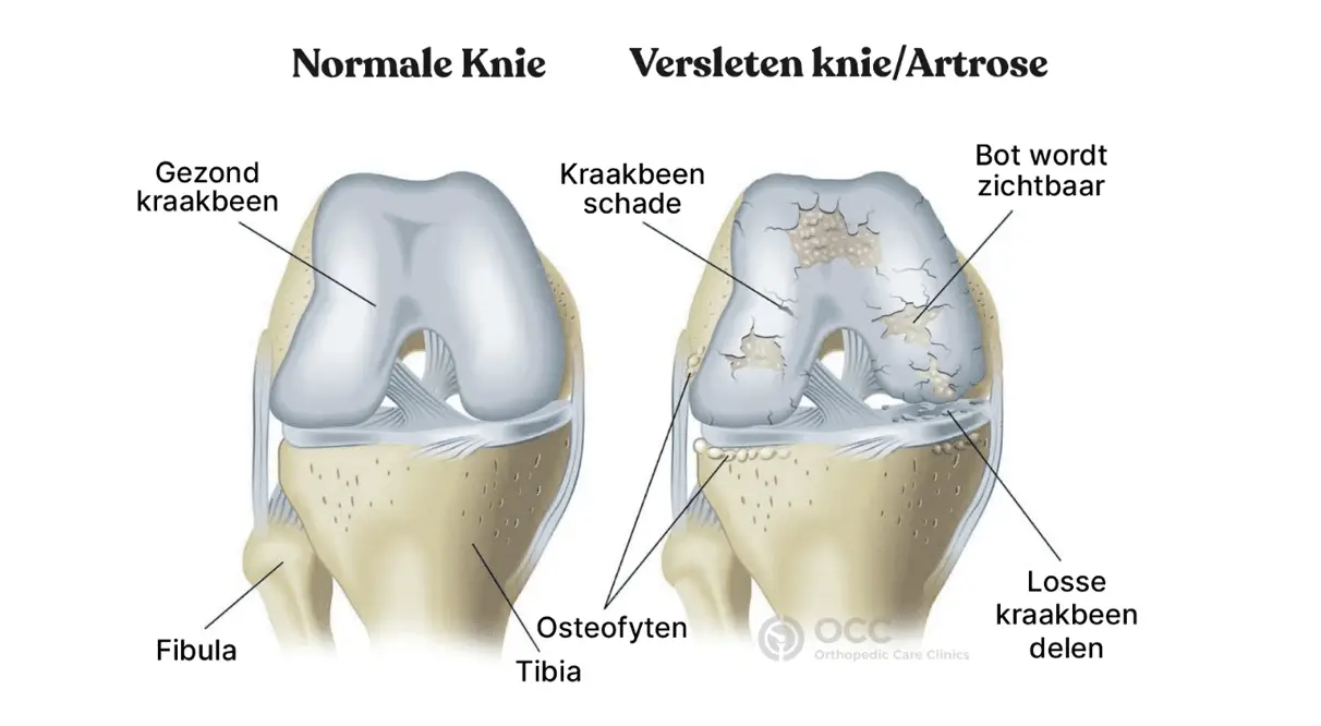 Anatomische illustratie ter vergelijking van een gezonde knie met een versleten knie met schade aan het kraakbeen.