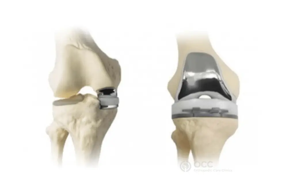 Anatomische illustratie weergave voor en zij aanzicht met een knie prothese.