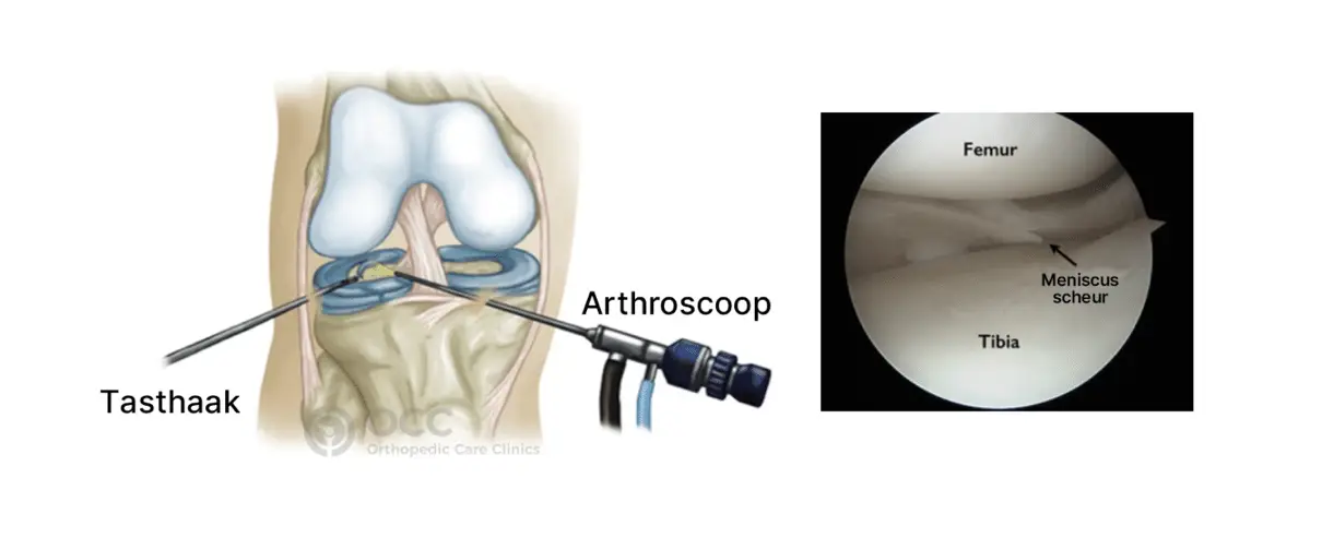 Anatomische illusatrie voorzijde meniscusscheur behandeling met arthroscoop en testhaak, naast de illustratie is een echte foto van binnenkant knie en de meniscusscheur.