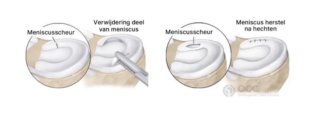 Anatomische illustratie met weergave verwijdering deel van meniscus en het hechten van de scheur.