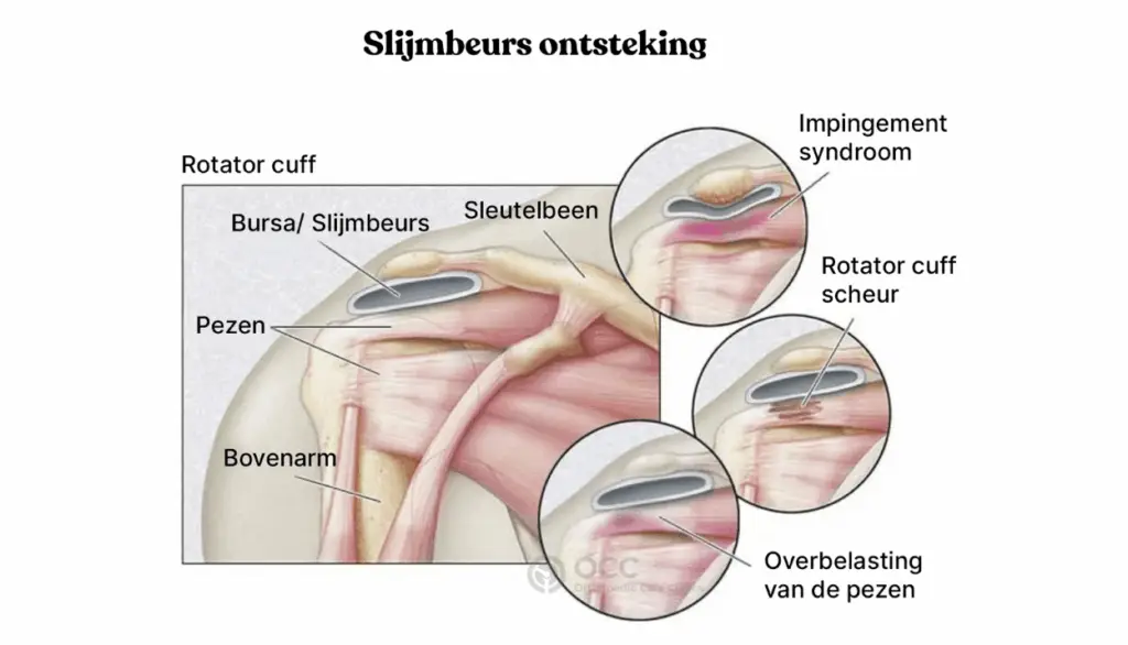 Anatomische illustratie van SAPS een slijmbeurs ontsteking en de rotator cuff.