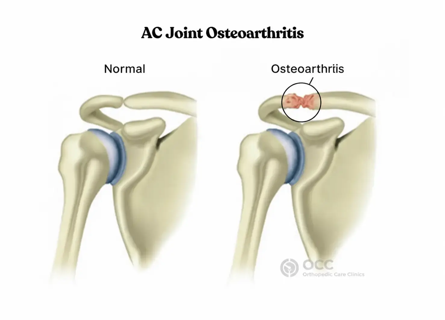 Illustration comparing a normal AC joint with an AC joint affected by osteoarthritis.